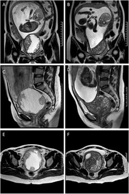 Primary primitive neuroectodermal tumor of the cervix confirmed with molecular analysis in a pregnant woman: A case report and literature review